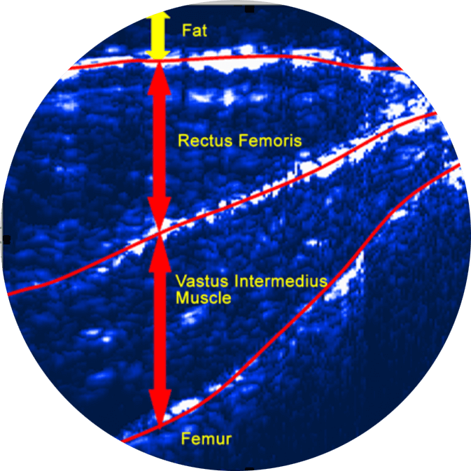 Exemplo de imagem de ultrassom para exame Bodymetrix